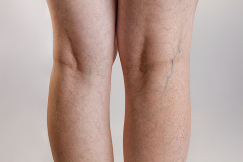 Varices sur jambe Centella asiatica